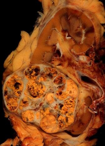 Carcinom renal