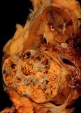 Carcinom celulă renală